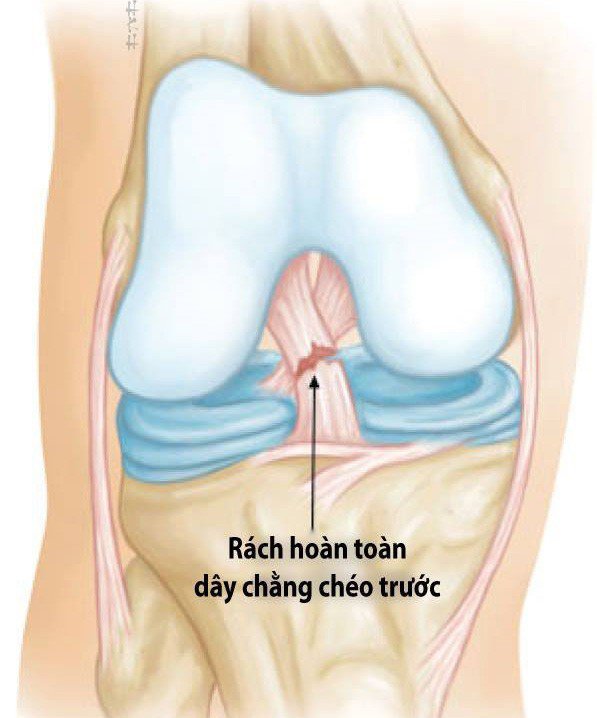 Bị đứt dây chằng chéo khớp gối bao lâu có thể chơi thể thao trở lại?