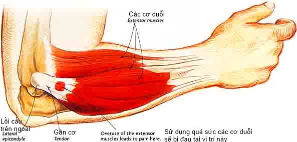 Hội chứng Tennis Elbow - Đau khuỷu tay do đánh Tennis 1