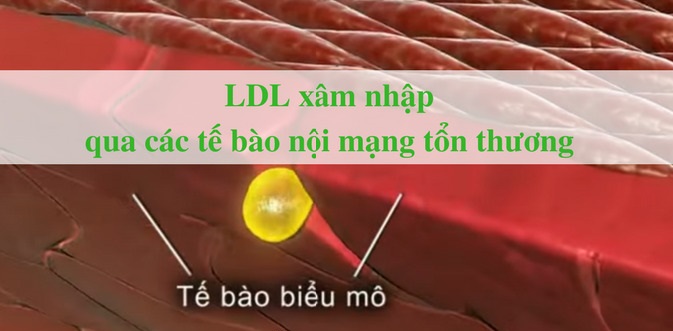 Huyết áp cao gây xơ vữa động mạch 3