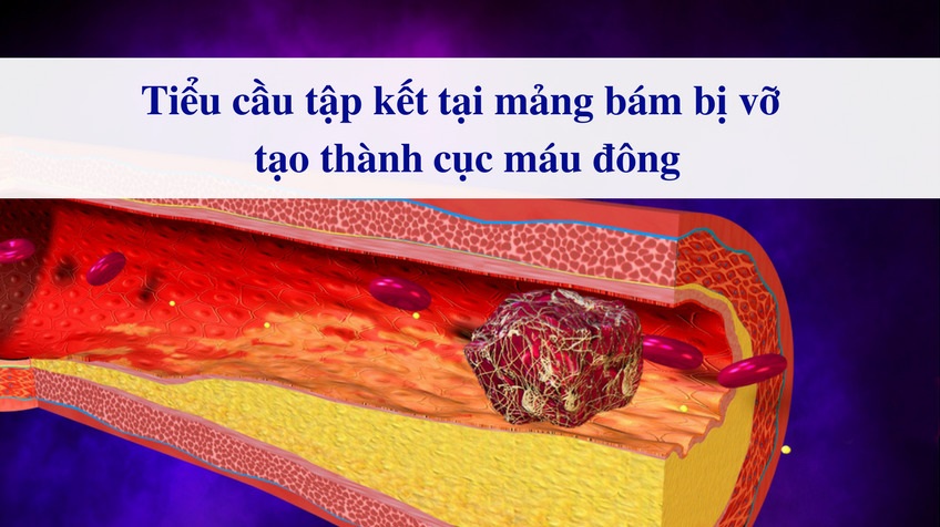 Huyết áp cao gây xơ vữa động mạch 5