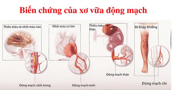 Huyết áp cao gây xơ vữa động mạch 6