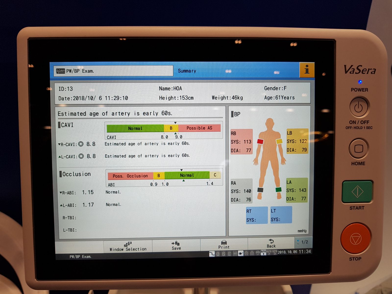 Thiết bị mới cho việc chẩn đoán bệnh xơ vữa động mạch Vasera VS-2000 1