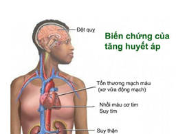 Huyết áp cao gây xơ vữa động mạch