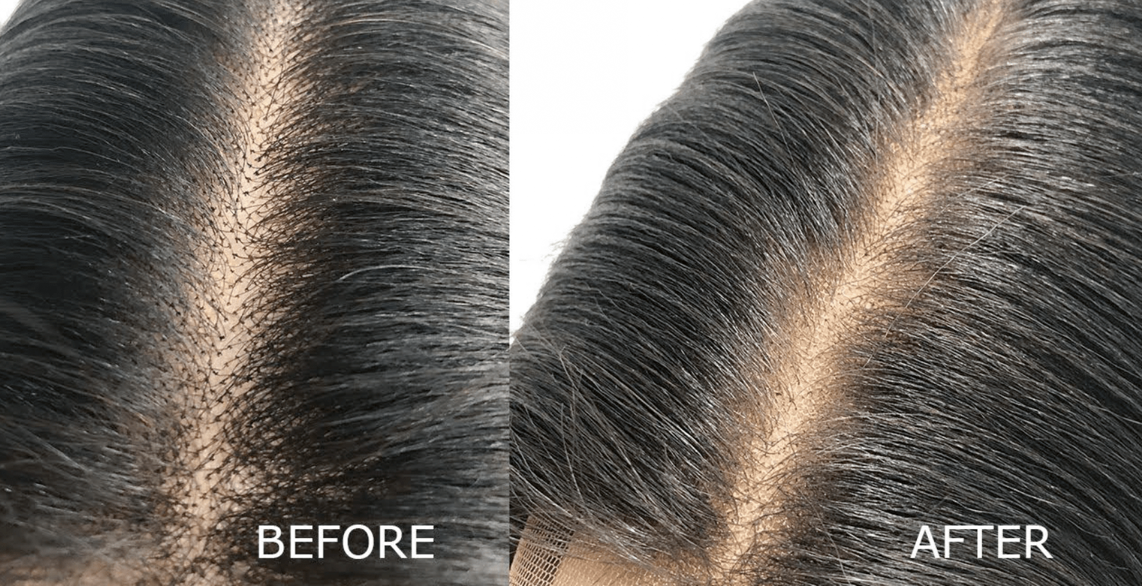 Bleaching Knots On Lace Closure: Why & How?