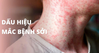 Khuyến cáo phòng chống bệnh sởi 