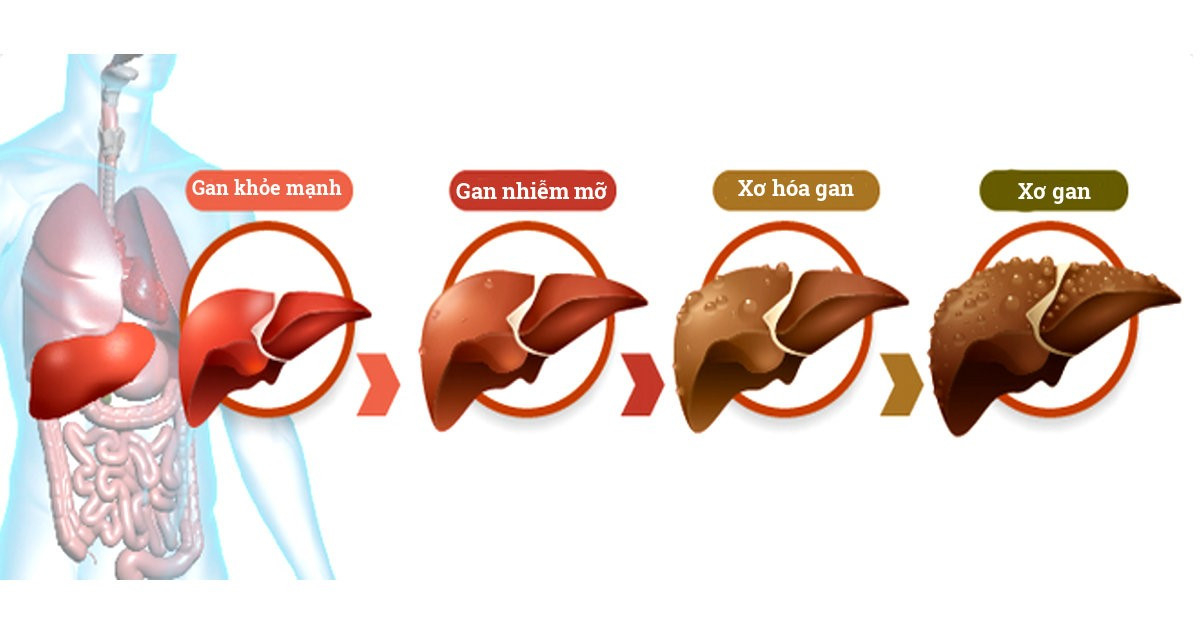 Đừng để lá gan của bạn bị kiệt sức vì uống nhiều rượu bia 1