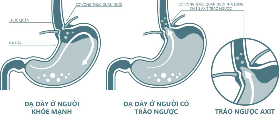 Vai trò của alginate và thuốc kháng axit trong điều trị trào ngược dạ dày
