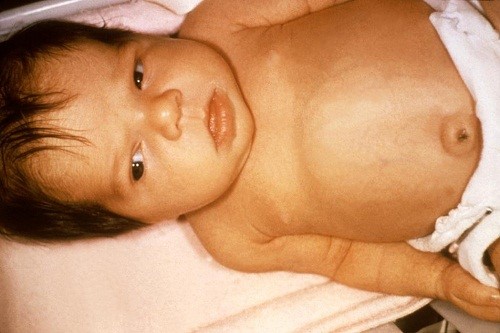 Sàng lọc sơ sinh - Bảo vệ bé yêu từ những khoảnh khắc đầu đời 3