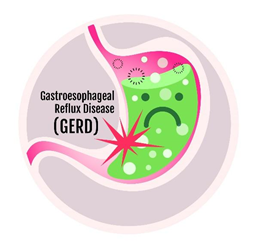Điều chỉnh thói quen sinh hoạt và thức ăn để giảm trào ngược dạ dày-thực quản