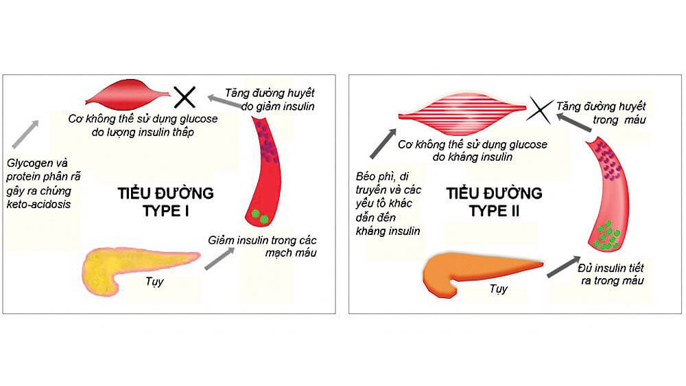 ảnh hưởng tuyến tụy đến bệnh tiểu đường